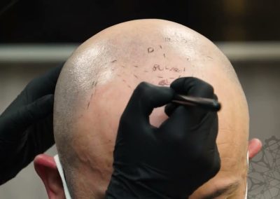 Alternatives to Hair transplant for Men. Scalp Micropigmentation Video Tutorial